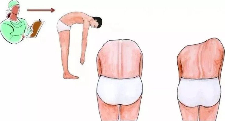脊柱側(cè)彎早發(fā)現(xiàn)，早治療